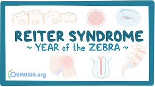 Reiter syndrome Year of the Zebra [upl. by Nyladnohr]