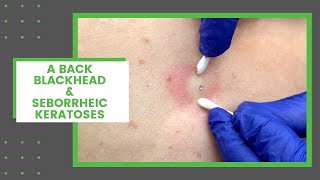 A Back Blackhead amp Seborrheic Keratoses  Dr Derm [upl. by Ashton893]