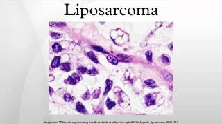 Liposarcoma [upl. by Marina547]