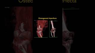 Osteogenesis Imperfecta [upl. by Liagabba]