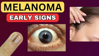 6 Weird Signs That You Have Melanoma [upl. by Vere]