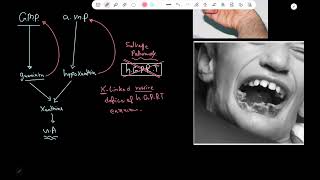 LeschNyhan syndrome  Pathology [upl. by Christiane]