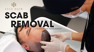 Perfecting Scab Removal on Day 11 PostHair Transplant Guide by Sule Hair Clinic [upl. by Notsyrb]