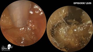 1535  Doctor Attends After Pushing Ear Wax On To Their Eardrum With Cotton Bud [upl. by Eicrad]