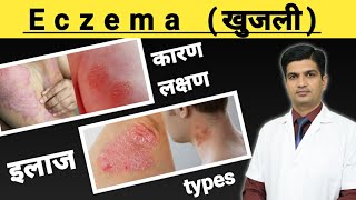 Eczema Treatment  Eczema kya hota hai [upl. by Glassman854]