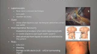 What is a Cholecystectomy [upl. by Anthe804]