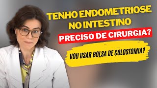 Tenho endometriose no intestino Preciso de cirurgia Vou usar bolsa de colostomia [upl. by Yereffej]