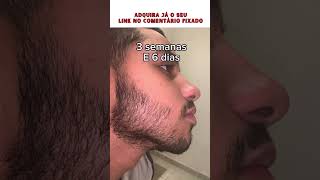 RESUKTADO MINOXIDIL SPRAY minoxidil [upl. by Nnyre]