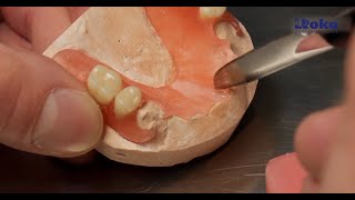 Thermoplastic dentures  Repair and service [upl. by Earahc211]