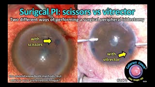 CataractCoach™ 2170 surgical peripheral iridectomy with scissors or vitrector [upl. by Cuthbert332]