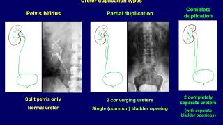 Intravenous Urography basics [upl. by Enaj]