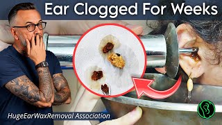 Ear wax removal water flush earwaxremoval earcleaning [upl. by Nerhtak]