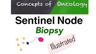 Sentinel node biopsy  A simple way to Understand [upl. by Ilram]