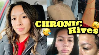 STORYTIME Diagnosed with Chronic Urticaria  Chronic Hives  PICTURES INCLUDED [upl. by Cyndia]