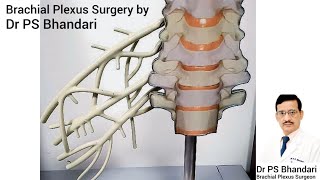 Post surgical results in Brachial plexus injury [upl. by Aihsia]