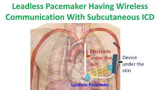 Leadless pacemaker having wireless communication with subcutaneous ICD [upl. by Grayce]