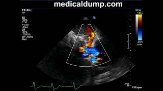 Severe Tricuspid Regurgitation  Transthoracic Echocardiogram TTE [upl. by Haral600]