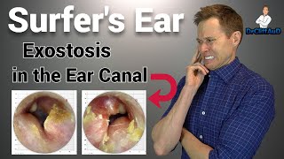 CRAZY Growth in the Ear Canal  Surfers Ear due to Exostosis [upl. by Cichocki]