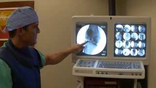 Introduction to fluoroscopic guided injection of stem cells by Harry Adelson ND [upl. by Fayola]