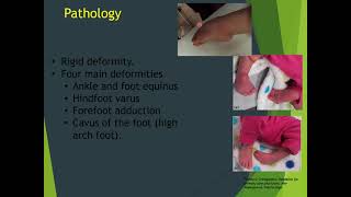 Common pediatric foot deformities first part [upl. by Derfiniw]