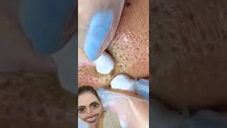 Blackheads Removal  Acne Treatment and Very Satisfying Satisfying Pimple pop blackheads [upl. by Netsrik]