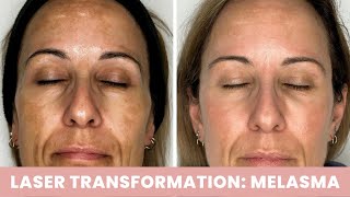 Watch Monicas Melasma Transformation with Laser [upl. by Centeno]