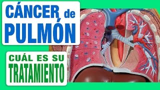 Cáncer de Pulmón  Tratamiento [upl. by Beasley]