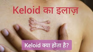 Keloid का इलाज  Hypertrophic Scar  Keloid treatment  keloid injection treatment  keloid scar [upl. by Lily462]