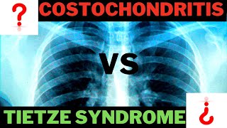 Tietze Syndrome OR Costochondritis [upl. by Rihsab963]