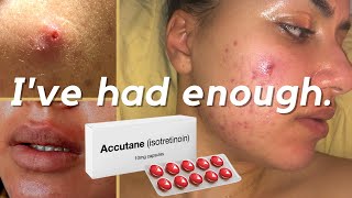 Why Im Starting Accutane Isotretinoin For My Cystic Acne 40mg Accutane Journey accutane acne [upl. by Irena701]