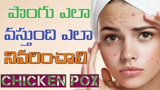 Home remedies for chicken pox in telugu  Chickenpox in telugu  Varicella  ammoru atalamma pongu [upl. by Hedley]