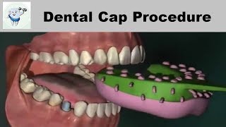 Dental Cap Fixing Procedure [upl. by Darcee]