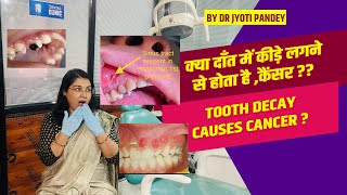 क्या दाँत में कीड़े लगने से होता है कैंसर  Is tooth decay causes CANCER [upl. by Diba127]