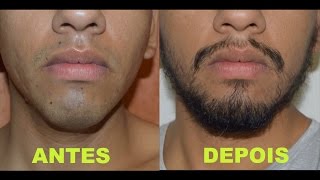 Antes e depois  minoxidil kirkland  barba  7 meses [upl. by Haldan]