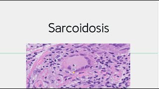 Sarcoidosis  Morphology Pathogenesis [upl. by Eciralc]