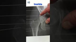 Understand Your XRay  Snapping Hip [upl. by Ahras]