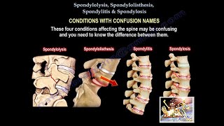 Spondylolysis Spondylolisthesis Spondylitis SpondylosisEverything Need To KnowDr Nabil Ebraheim [upl. by Morris476]