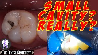 Molar Tooth Caries Removal and Restoration Pasta sa Bagang42 [upl. by Juditha]