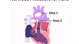 Norwood Procedure for Hypoplastic Left Heart Syndrome [upl. by Rma803]