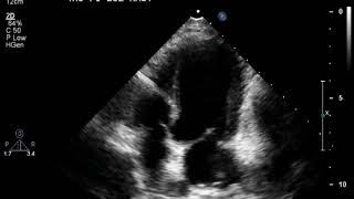 Mitral valve stenosis in a dog [upl. by Kneeland335]