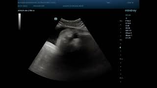 Cleft lip and palate ultrasound [upl. by Salomone]