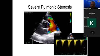 45th Course 202205 15 Pulmonic Stenosis [upl. by Lig]