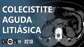 COLECISTITE AGUDA LITIÁSICA NA TC [upl. by Ativla]