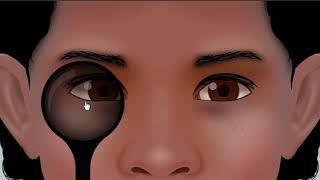 examination of esotropia  animation [upl. by Eldreda711]