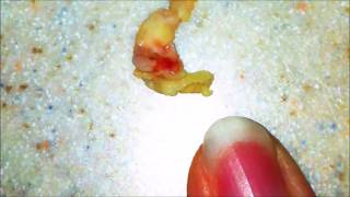 Worlds Largest Tonsil Stones  Cured [upl. by Demetris]