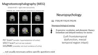 Periventricular Nodular Heterotopia with Samden Lhatoo MD and Nitin Tandon MD [upl. by Puiia582]