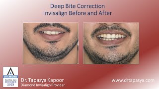 Deep Bite Correction  Invisalign Before and After [upl. by Samul]