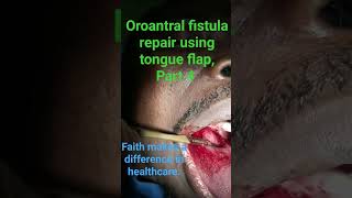 Oroantral fistula repair using anteriorly pedicled tongue flap tongue flap harvesting havefaith [upl. by Dilahk]