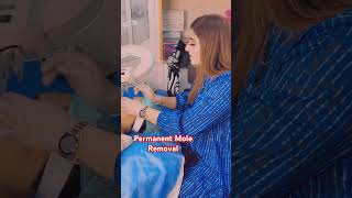 Mole Removal permanentmoleremover shortvideo Sunaina beauty zone [upl. by Feinleib]