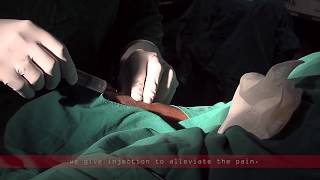 Coronary angiogram  a live demonstration [upl. by Biagio60]